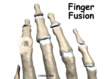 Finger Fusion Surgery - Holsman Physical Therapy and Rehabilitation P.C.'s Guide