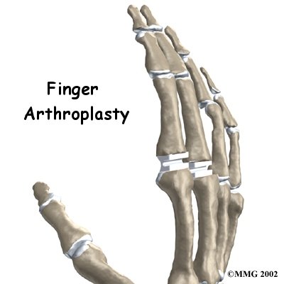 Artificial Joint Replacement of the Finger - Holsman Physical Therapy and Rehabilitation P.C.'s Guide