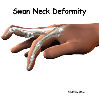 Swan Neck Deformity of the Finger